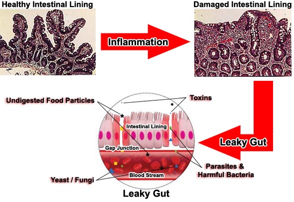 leaky gut and inflammation