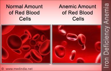 iron-deficiency-anemia