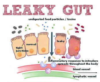 leaky gut issues