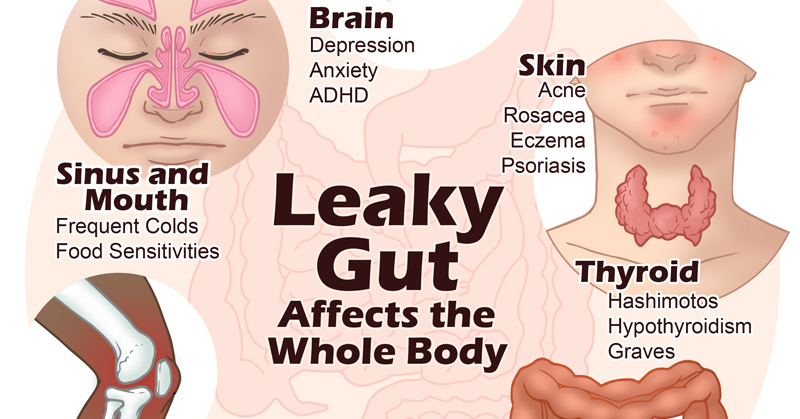 The Top 5 Causes Of Leaky Gut And How