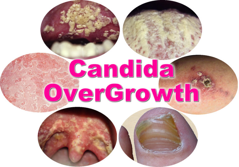 candida overgrowth face