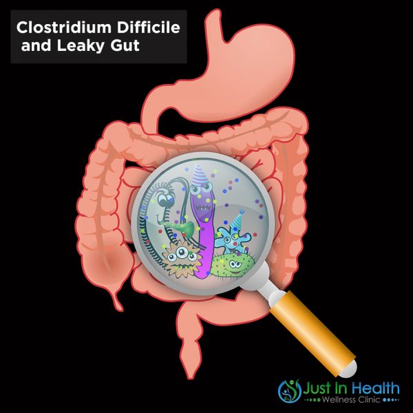 Clostridium Difficile and Leaky Gut