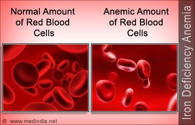 Nutrition and Anemia