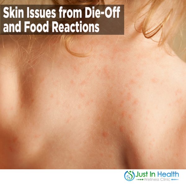 Skin Issues from Die-Off and Food Reactions