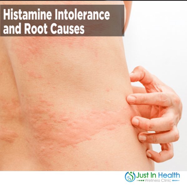 Histamine Intolerance and Root Causes