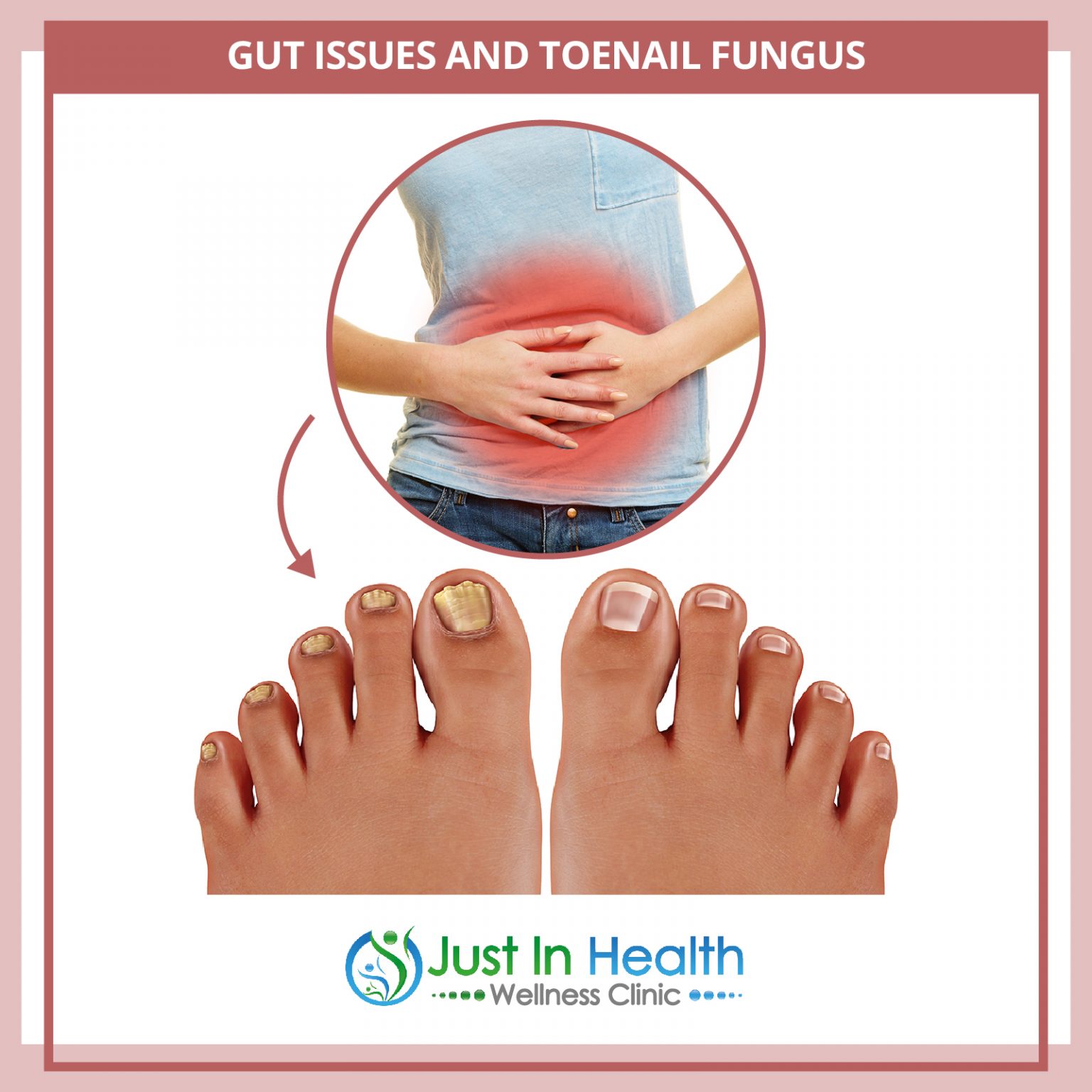 How To Treat Toenail Fungus or Discoloration Austin Texas Functional