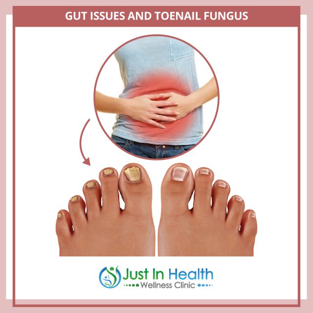 How To Treat Toenail Fungus or Discoloration Austin Texas Functional