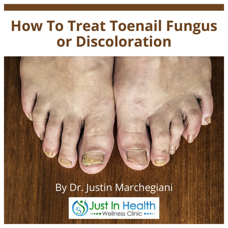 How To Treat Toenail Fungus Or Discoloration - Austin Texas Functional ...