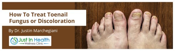 How To Treat Toenail Fungus or Discoloration
