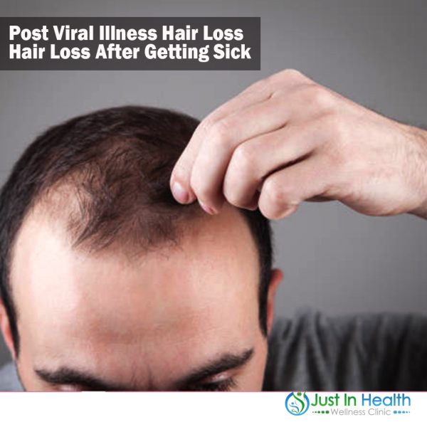 Post Viral Illness Hair Loss - Hair Loss After Getting Sick Podcast #386